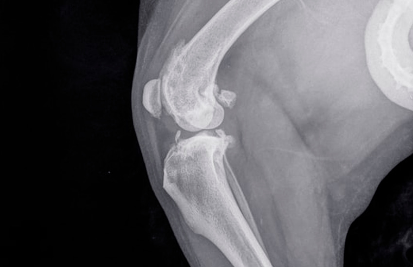 Las 6 principales causas de la Osteoartritis